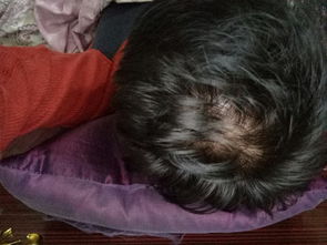 本人男今年20岁,每次洗头都会掉好多头发,发现部分头发从根部就断了,用手摸头皮的时候就扎手,差不多 