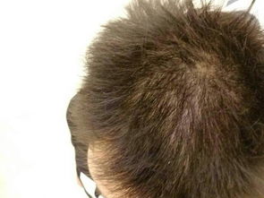这样的算不算头发希薄,每次洗头都要掉20 30根左右,有什么方法能让头发变多起来 